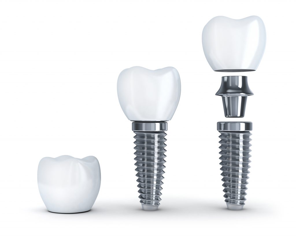 Zahnimplantate Implantatologie